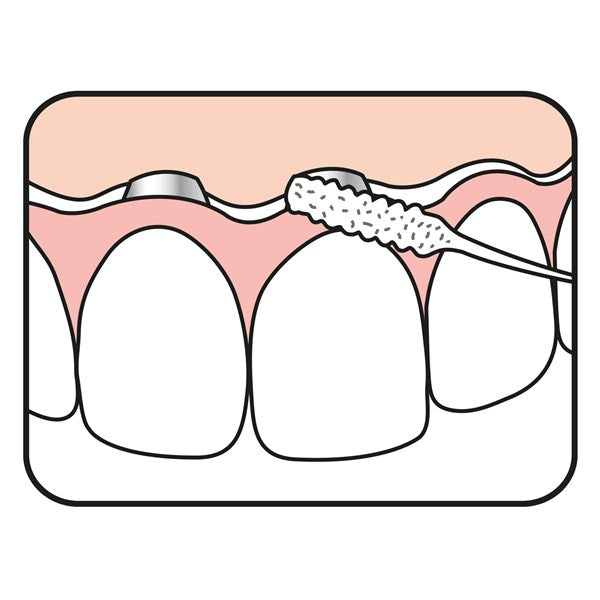 TePe Bridge Implant Floss para implantes y ortodoncia