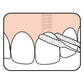 TePe Bridge Implant Floss para implantes y ortodoncia